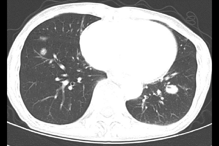 リンパ増殖性疾患：多発性肺浮腫癌図3