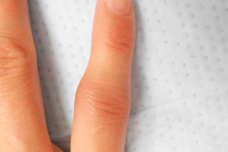 関節リウマチの発疹の写真