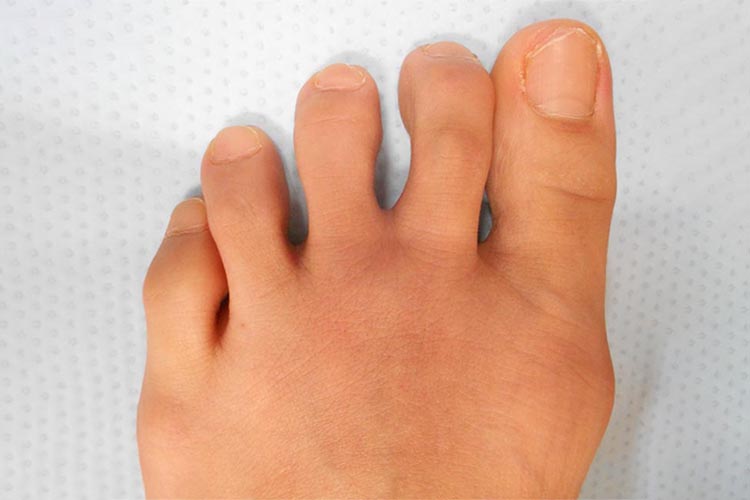 関節リウマチ患者さんの足の写真