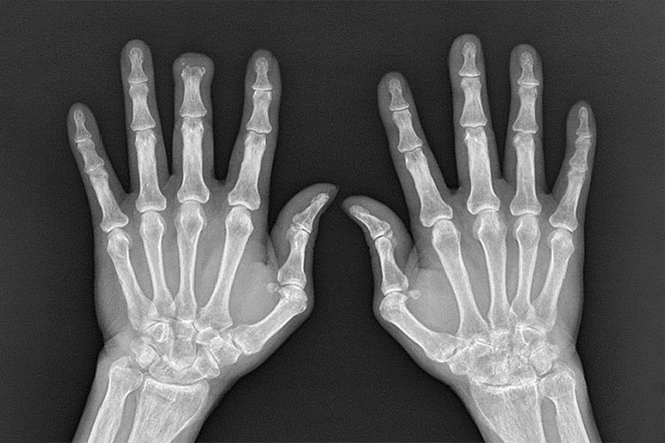 RF・抗CCP抗体正常の関節リウマチ患者さんの手のレントゲン